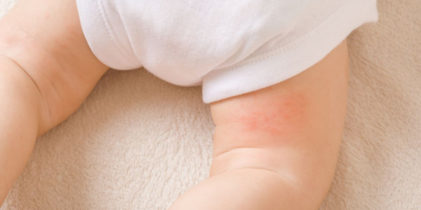 Sauskelnių bėrimas? Kas ir kaip?